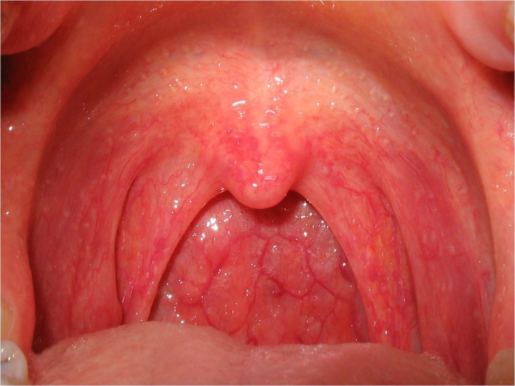 Oral cancer detection