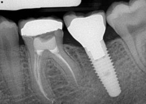 Connecticut Dental Implant